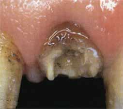 Имплантация зубов - перелом корня верхнего левого центрального резца