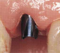 Имплантация зубов - фиксация прототипа абатмента