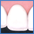 Винир, установленный на здоровый зуб