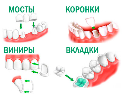 Протезирование зубов в Белоруссии виды, цены, отзывы (2023)